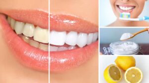 cách làm trắng răng tại nhà