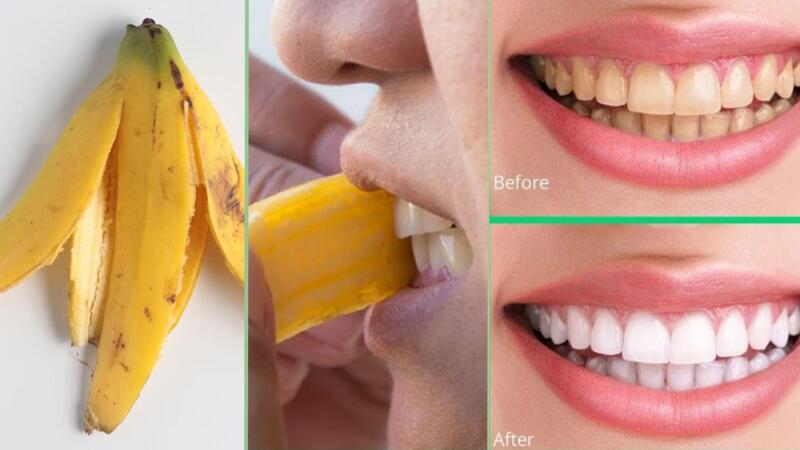 Tẩy trắng răng ố vàng tại nhà bằng vỏ chuối