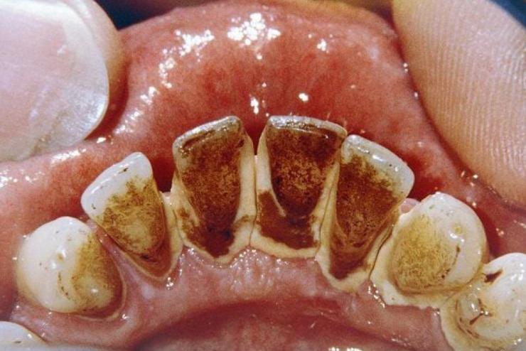 Vôi răng huyết thanh thường có màu đỏ nâu hoặc nâu sậm