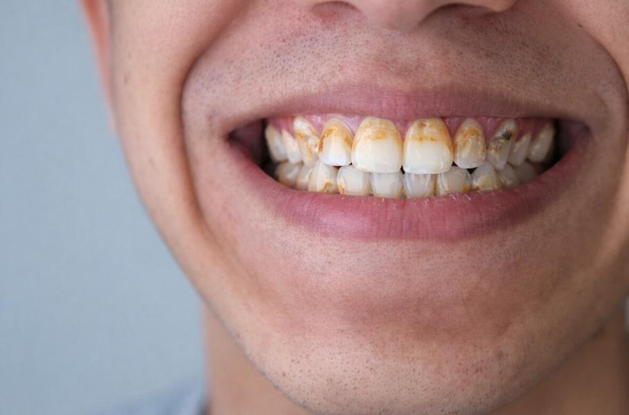 Vôi răng làm mất tính thẩm mỹ, thiếu tự tin khi giao tiếp